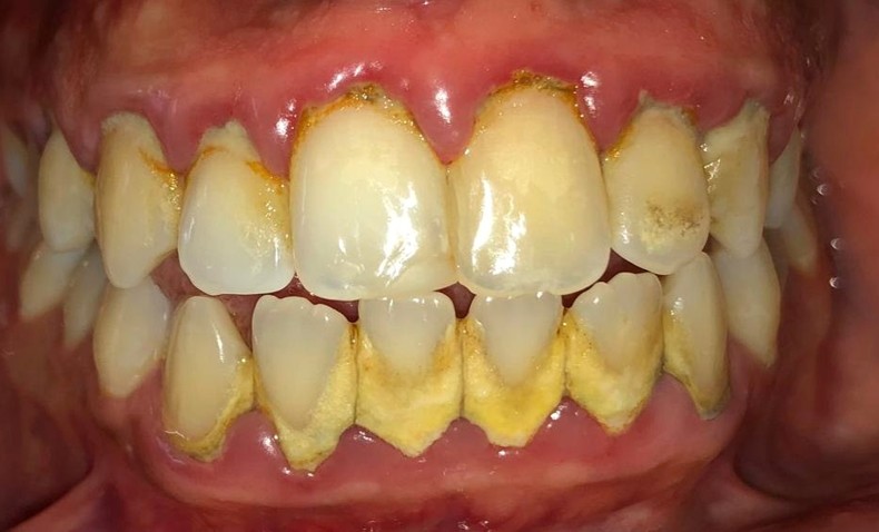 Antes de limpieza dental profunda