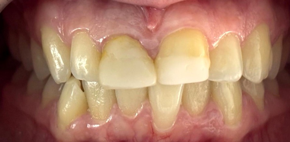 Antes del tratamiento dental